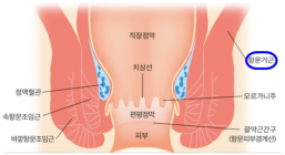 [일문일답 생활 속 건강] 항문거근증후군