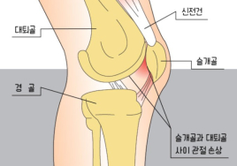 [일문일답 생활 속 건강] 슬개대퇴통증증후군