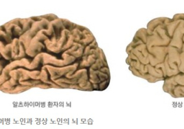 美 연구팀, 알츠하이머병 위험 70% 낮추는 유전자 변이 발견