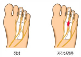 늙기 전에 ‘발 건강’부터 ⑤ 지간신경종과 예방법