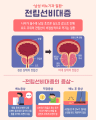 전립선 질환의 예방과 치료 ② 전립선 비대증 원인과 증상